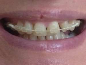 My-6-Month-Smile-Experience