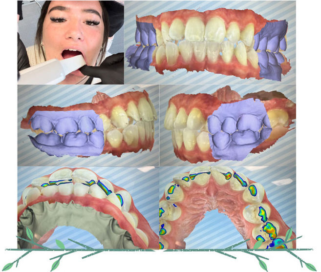 Dental Braces