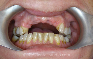 Dental Dentures in Colchester