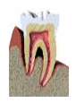 Periodontal Disease