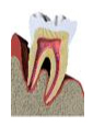 Periodontal Disease