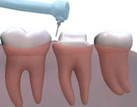 Cerec Crowns in Colchester