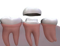 Cerec Crowns