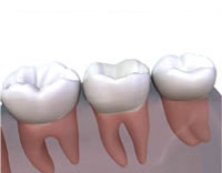 Cerec Crowns